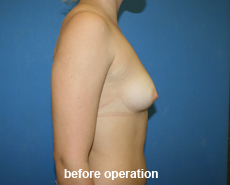 plastic-surgery-breast-augmentation